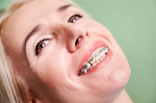 Benefits Of Adult Orthodontics