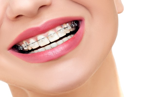 Popular Adult Orthodontic Treatments