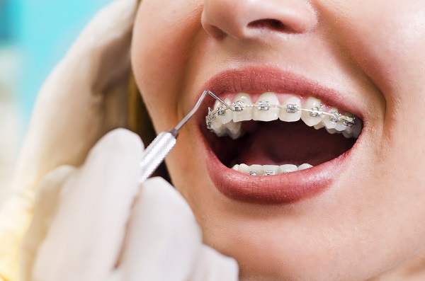 How To Choose Between Braces And Clear Aligners