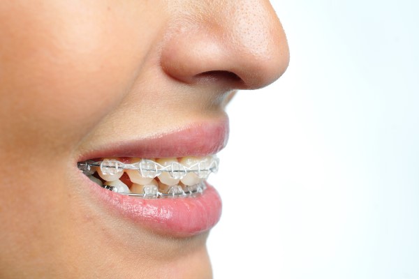 The Pros And Cons Of Clear Braces