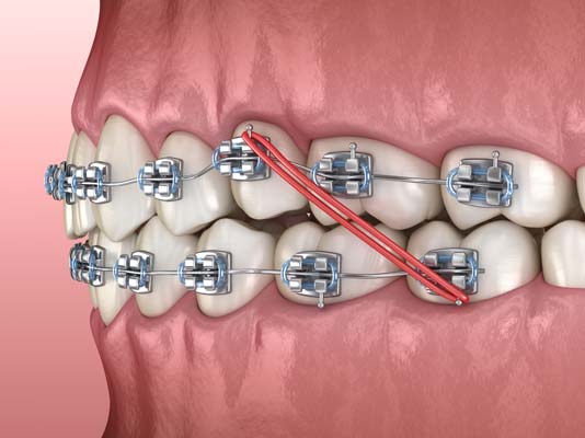 Corrective Braces For An Overjet