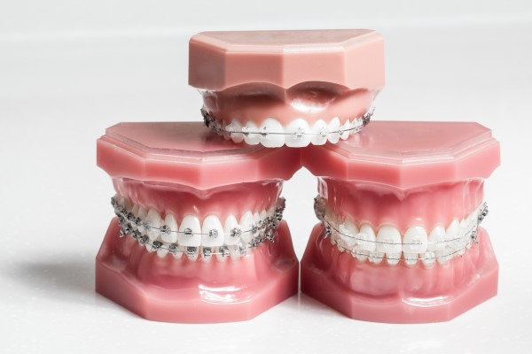 Damon Braces Vs  Traditional Braces: What Sets Them Apart?