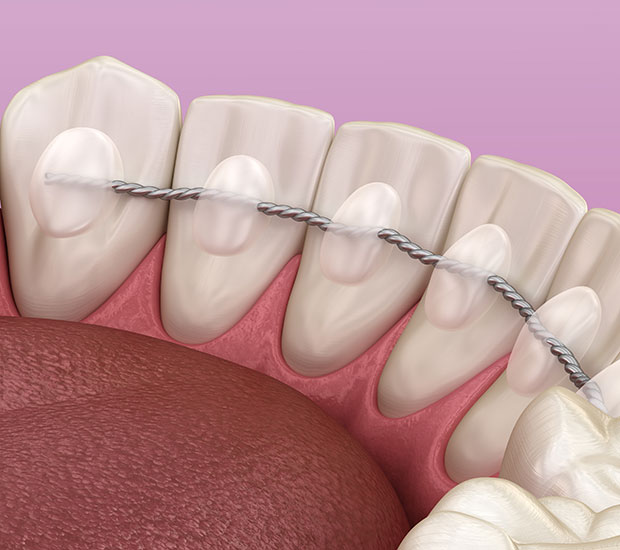 Frisco Fixed Retainers