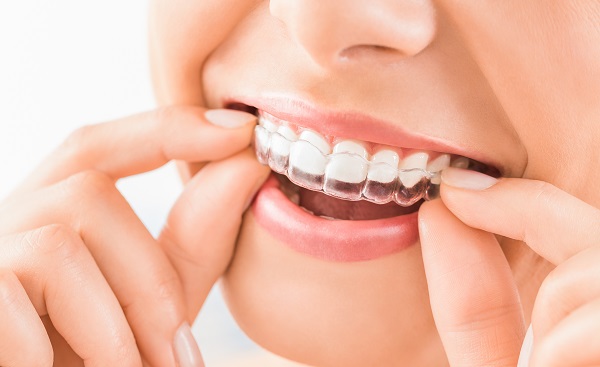 Important Things To Know Before Clear Aligners Teeth Straightening