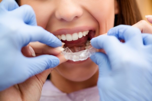 What To Consider When Looking For &#    ;Invisalign Near Me&#    ;