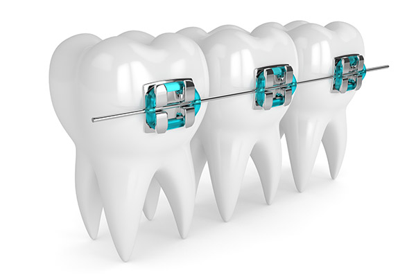 How an Orthodontist Fixes Crowded Teeth With Braces from Price Family Orthodontics in Frisco, TX