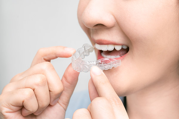 Overview Of Clear Aligner Orthodontic Therapy