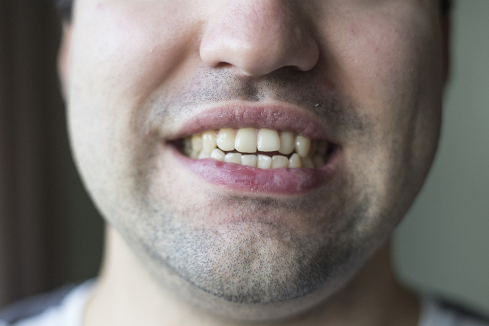 A Comparison Of Popular Teeth Straightening Options
