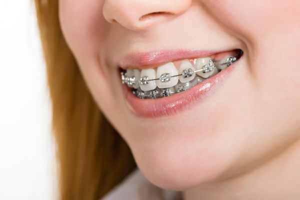 A Top Orthodontist Discusses Phase   Orthodontics