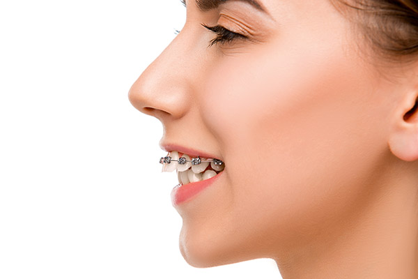 Orthodontist Treatment Options for an Overbite from Price Family Orthodontics in Frisco, TX