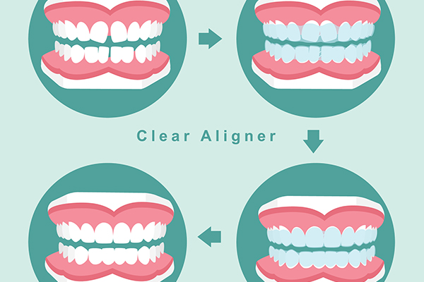 What To Expect When Getting Orthodontics Treatments